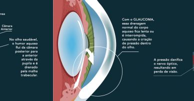 Cirurgia de Glaucoma