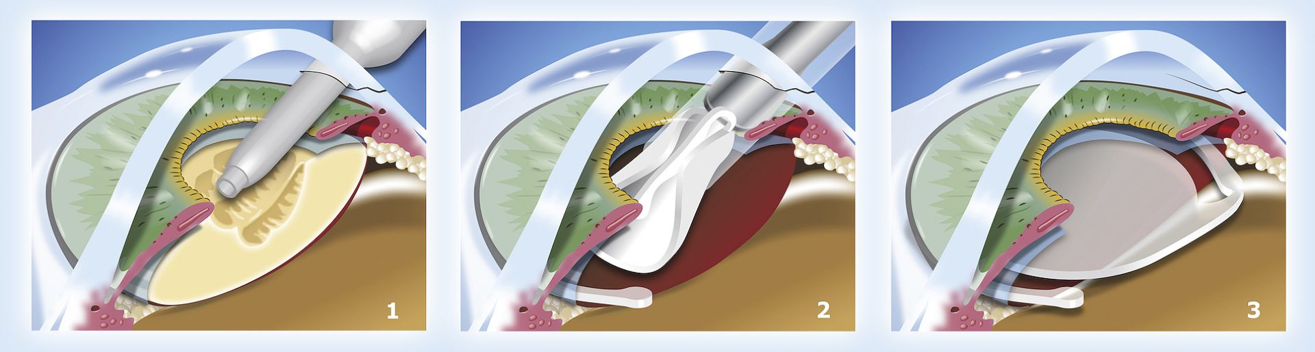 Cirurgia de Catarata Facoemulsificação