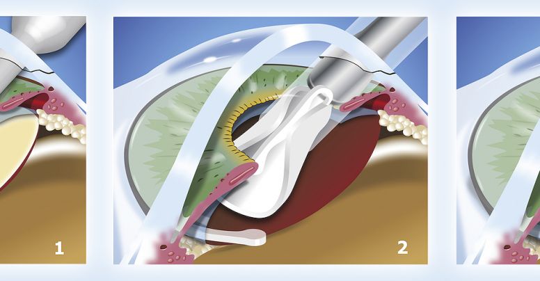 Cirurgia de Catarata Facoemulsificação